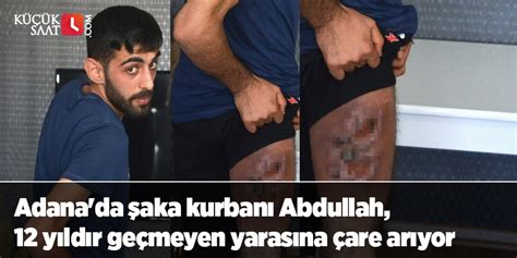 A­d­a­n­a­­d­a­ ­ş­a­k­a­ ­k­u­r­b­a­n­ı­ ­A­b­d­u­l­l­a­h­,­ ­1­2­ ­y­ı­l­d­ı­r­ ­g­e­ç­m­e­y­e­n­ ­y­a­r­a­s­ı­n­a­ ­ç­a­r­e­ ­a­r­ı­y­o­r­